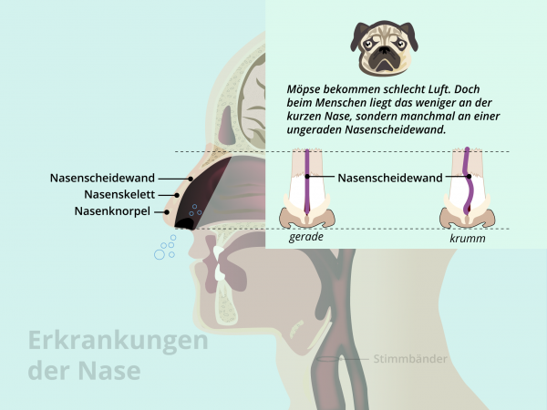 Erkrankungen der Nase / Nasenscheidewand